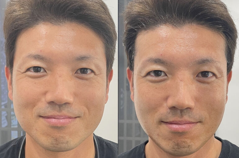 ハイフで小顔になる40代男性