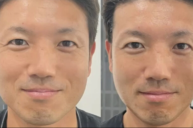 初めてのハイフ