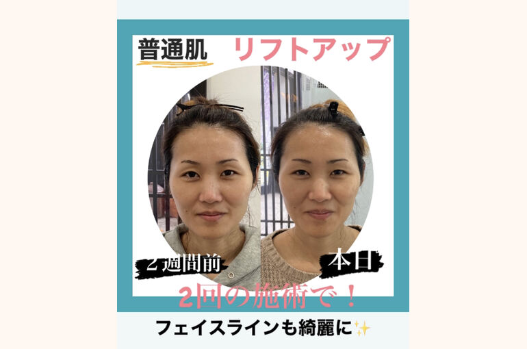 フェイスラインのたるみのケア