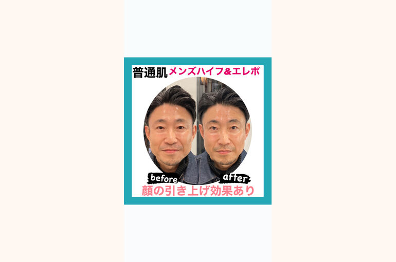 美容男子　たるみ　メンズハイフ