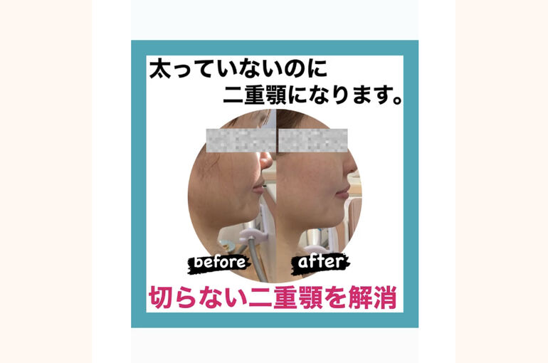 二重顎　ハイフ