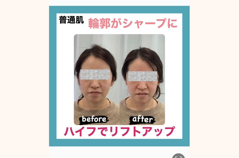 ハイフ　エレクトロポレーション　輪郭　シャープ　リフトアップ