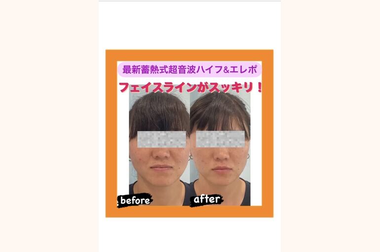 最新蓄熱式超音波　エレクトロポレーション