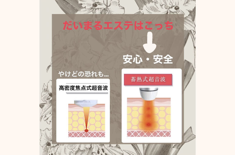 蓄熱式超音波ハイフ
